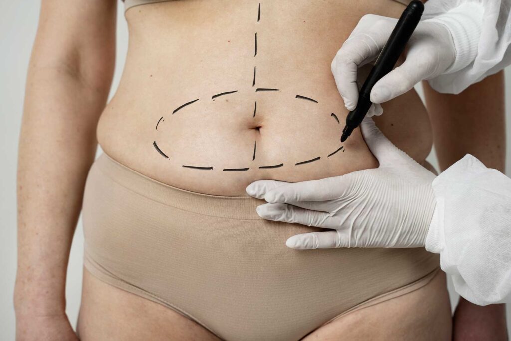 Qué es el Lipofilling